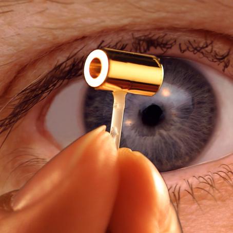 Hohlraum. (Source: Wikipedia.org) Hohlraum. (Source: Wikipedia.org)