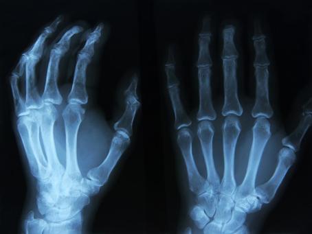 X-ray image of a patient’s left hand. The oldest image in the history of medical diagnostics is the 2D image of a hand’s interior structure. (Source: © Tsiumpa / stock.adobe.com) X-ray image of a patient’s left hand. The oldest image in the history of medical diagnostics is the 2D image of a hand’s interior structure. (Source: © Tsiumpa / stock.adobe.com)