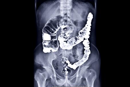 Colon X-ray image made using a contrast medium with high capability of X-ray radiation absorption. (Source: © samunella / stock.adobe.com) Colon X-ray image made using a contrast medium with high capability of X-ray radiation absorption. (Source: © samunella / stock.adobe.com)